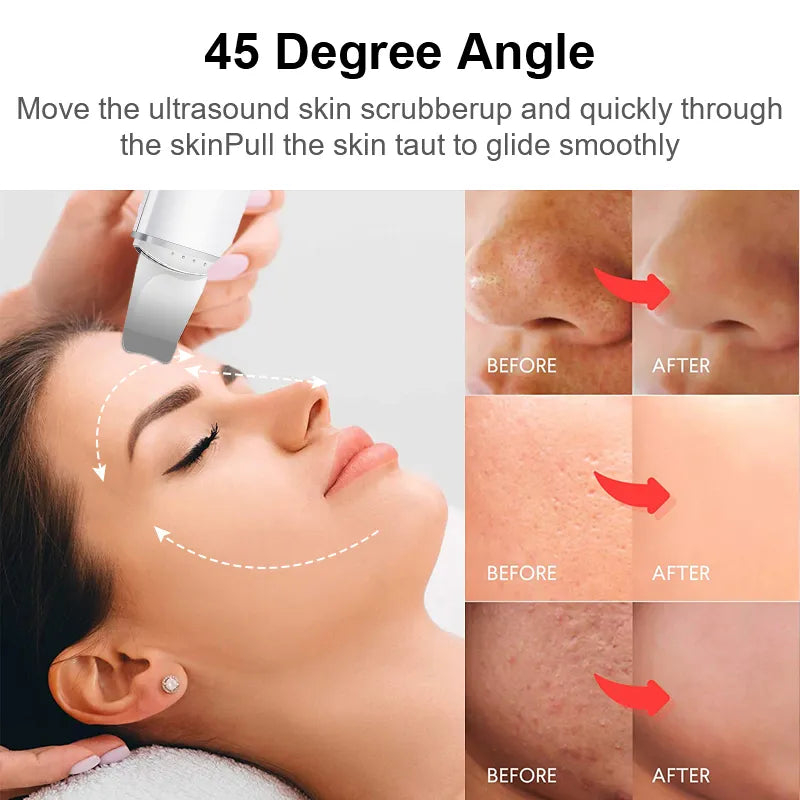 🌊 Ultrasonic Face Scrubber – Deep Pore Cleanser & Lifter 💆‍♀️